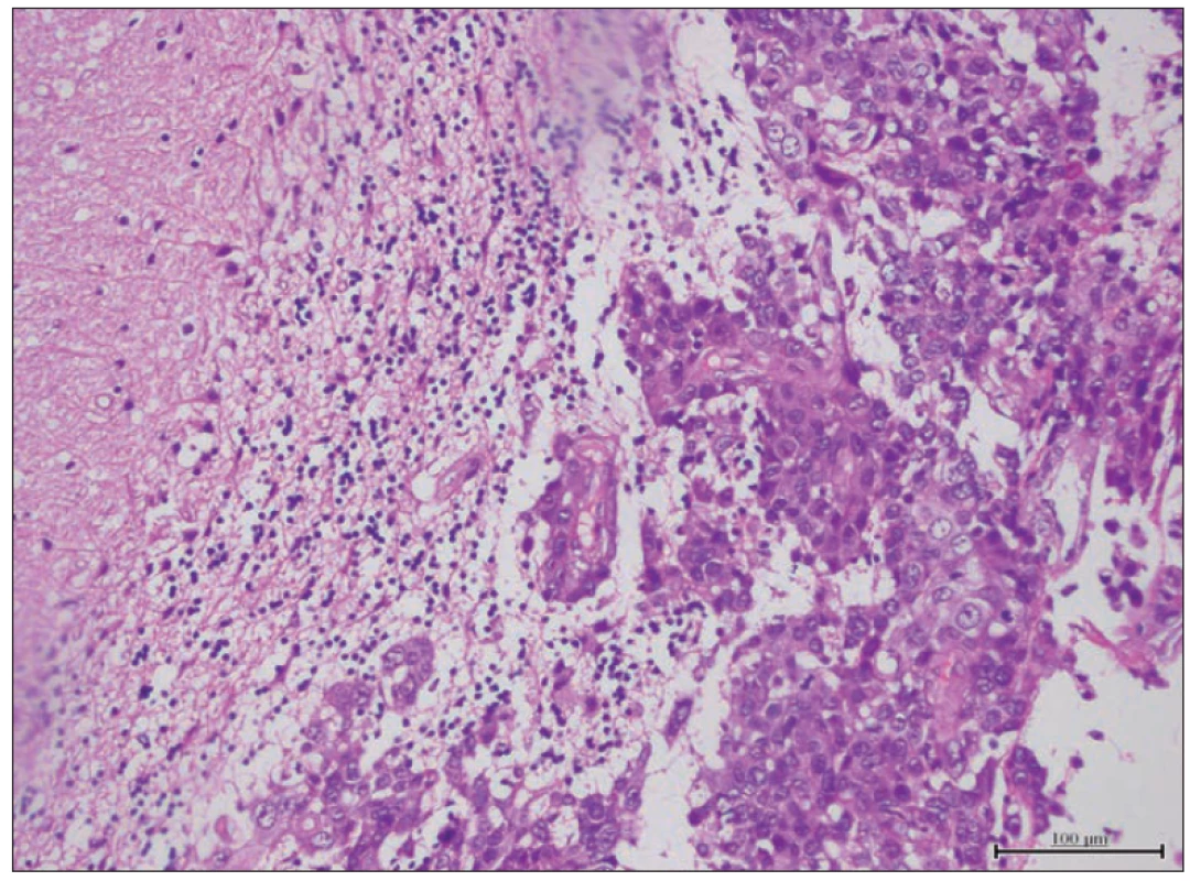 Paraffin section showing a metastatic squamous cell carcinoma (hematoxylin and
eosin).<br>
Obr. 2. Parafinový řez ukazující metastatický karcinom skvamózních buněk (hematoxylin
a eosin).