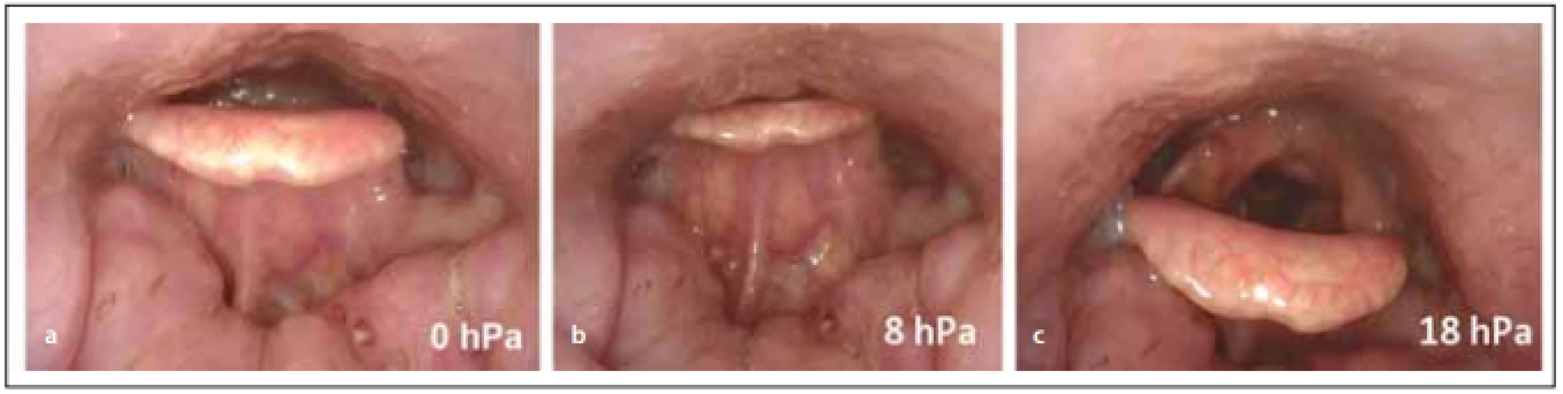 Endoskopie v uměle navozeném spánku s CPAP, pohled do hypofaryngu a na vchod hrtanu fl exibilním endoskopem – (a) 
předo zadní obstrukce v oblasti epiglotis při tlaku 0 hPa; (b) kolaps epiglotis při použití tlaku 8 hPa, selhání CPAP, zhoršení obstrukce; (c) 
oddálení epiglotis od zadní stěny hltanu až při tlaku 18 hPa. <br>
Fig. 1. Drug-induced sleep endoscopy and CPAP, view of the hypopharynx and the entrance of the larynx with a fl exible endoscope – 
(a) the anterior-posterior obstruction of epiglottis at a pressure of 0 hPa; (b) collapse of the epiglottis at a pressure of 8 hPa, CPAP 
failure, worsening of obstruction; (c) removal of epiglottis from the posterior wall of the pharynx beyond the pressure of 18 hPa.