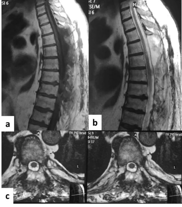 Postoperative spinal MRI. A – sagittal T1W, B – sagittal T2W, C – axial T2W. Total tumour resection and re-expansion of the spinal cord.