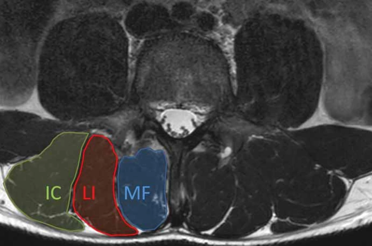 Axiální T2 vážený obraz MR bederní páteře na úrovni L4. Obrázek ukazuje normální
anatomii paraspinálních svalů. Musculus erector spinae je tvořen m. longissimus
(LI) a m. iliocostalis (IC). Multifidus (MF) je mediálně od m.erector spinae.<br>
Fig. 2. Axial T2-weighted MRI image of the lumbar spine at the level of L4. Figure shows
normal anatomy of paraspinal muscles. The erector spinae muscle consists of the longissimus
(LI) and iliocostalis (IC) muscles. The multifi dus (MF) is medial to the erector spinae
muscles.