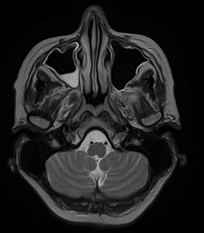 Brain MRI. Axial T2 weighted – sinusitis maxillaris right with edematous and thick mucosa, normal brainstem. <br>
Obr. 1. MR mozku. Axiální T2 vážený snímek – sinusitis maxillaris vpravo s edematózní a zesílenou sliznicí. Normální nález v oblasti mozkového kmene.