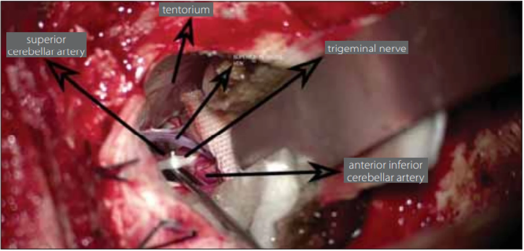 Placement of Tefl on between the trigeminal nerve and vascular structure.<br>
Obr. 1. Umístění tefl onu mezi trojklanný nerv a cévní strukturu.