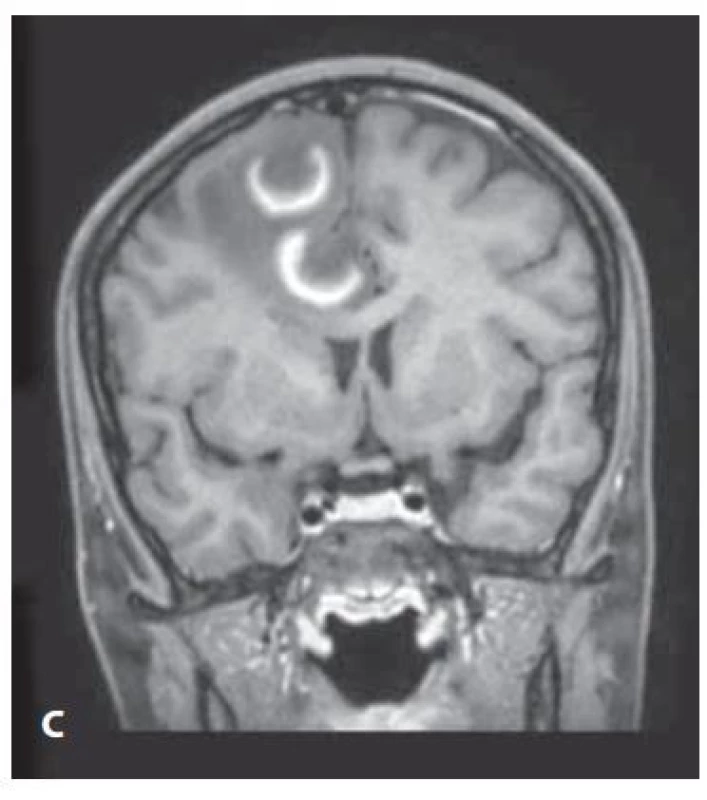 Iniciální MR mozku s gadoliniovou
kontrastní látkou – sekvence (A) FLAIR
transverzální, (B) T1 postkontrastně transverzální,
(C) T1 postkontrastně koronální.
Intraaxiální léze v pravé hemisféře s perifokálním
edém a se sycením vzhledu přerušeného
prstence.<br>
FLAIR – fluid attenuated inversion recovery<br>
Fig. 1. Initial brain MRI with gadolinium
contrast agent – (A) transverse FLAIR,
(B) transverse T1 contrast enhanced,
(C) coronal T1 contrast enhanced sequencies.
Intraaxial lesions in the right hemispehe
with perifocal edema and saturation
of the appearance of an open ring.<br>
FLAIR – fluid attenuated inversion recovery