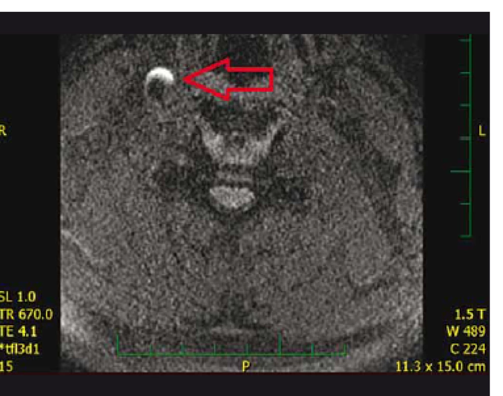 Hyperintenzita na 3D T1_MPRAGE krčních
obrazech MR hodnocená jako krvácení do aterosklerotického
plátu.<br>
Fig. 2. Hyperintensity on 3D T1_MPRAGE-MRI evaluated
as intraplaque hemorrhage.