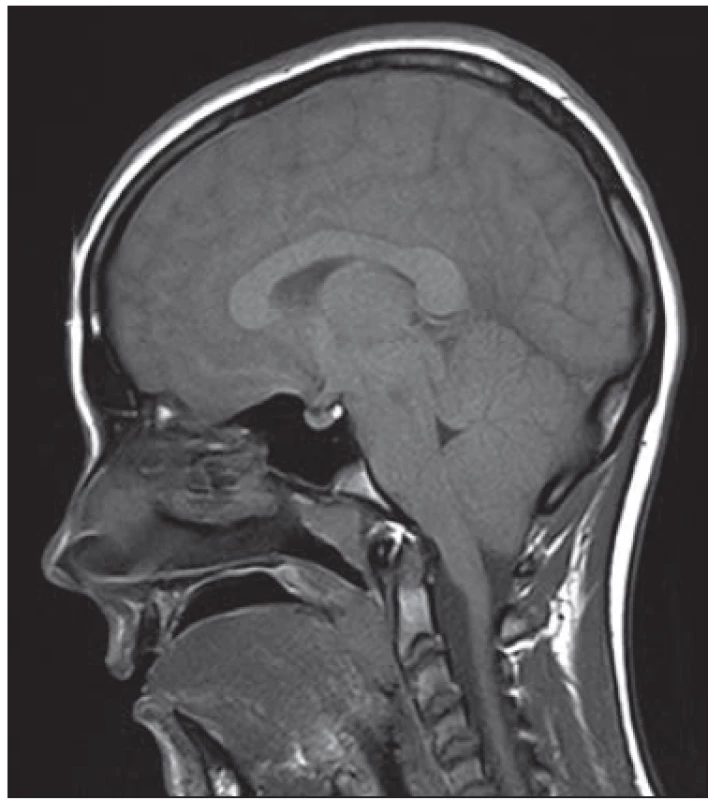 CT sken mozku, nativně, koronární
rovina. Postranní komory zúžené, III. komora
téměř zašlá, lehce setřelá diferenciace šedé
a bílé hmoty, oploštělá gyrifi kace, zúžené
subarachnoideální prostory.<br>
Fig. 1. CT scan of the brain, unenhanced,
coronal slice. Narrowed lateral ventricles,
IIIrd ventricle almost totally compressed,
slight loss of grey-white matter
diff erentiation, sulci eff acement,
subarachnoid space narrowing.