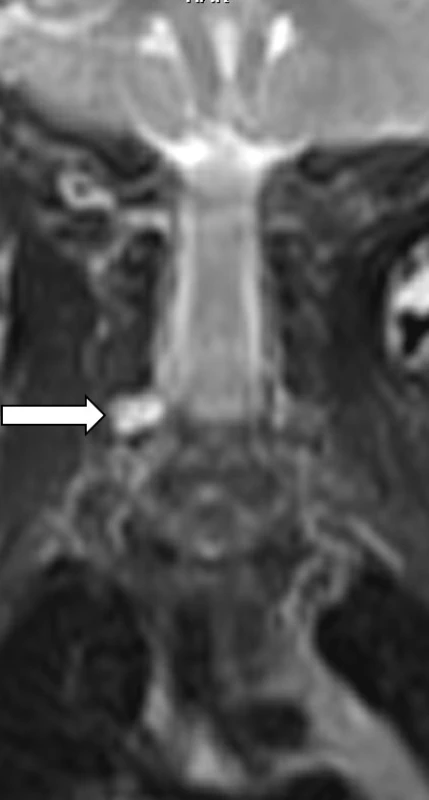 2D T2 vážený obraz, koronární rovina. Hypersignální pseudomeningocele v úrovni C5–6 vpravo.<br>
Fig. 7. MRI – 2D T2 weighted image, coronal plane shows  pseudomeningocele as hyperintense fluid collection at the level of right C5–6 neural foramen.
