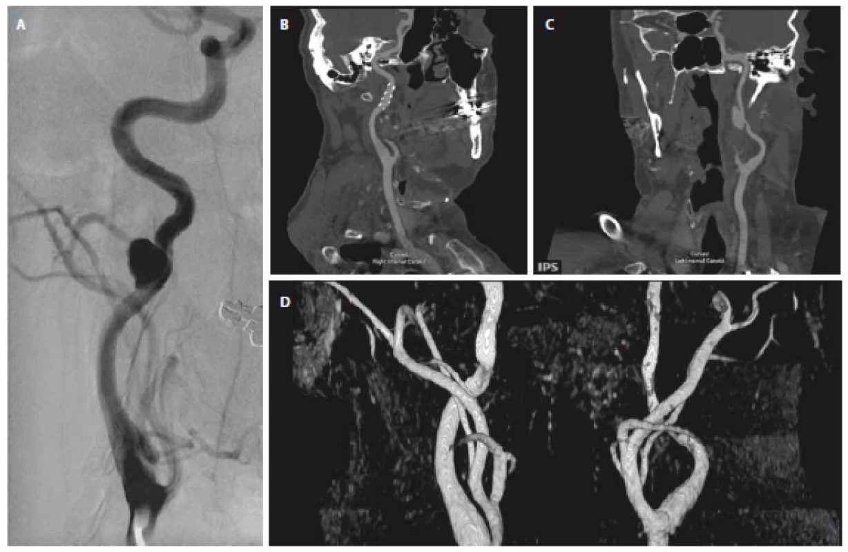 (A) Angiogram s PSA ACI vpravo; (B) průchodný stent a remodelace ACI vpravo 8 let po zavedení stentu na multiplanární rekonstrukci
z CTA (říjen 2017); (C) na CTA z října 2017 rovněž zjištěno PSA na ACI vlevo (multiplanární rekonstrukce); (D) MRA zobrazuje průchodné
ACI bilaterálně bez plnění PSA.
ACI – arteria carotis interna; PSA – pseudoaneuryzma<br>
Fig. 2. (A) Angiogram with PSA on the right ICA; (B) remodelling of the right ICA with patent stent on CTA performed in October 2017
(multiplanar reconstruction); (C) PSA of the left ICA on CTA performed in October 2017; (D) MRA of the carotid arteries without PSA
opacifi cation after stent implantation.
ICA – internal carotid artery; PSA – pseudoaneurysm