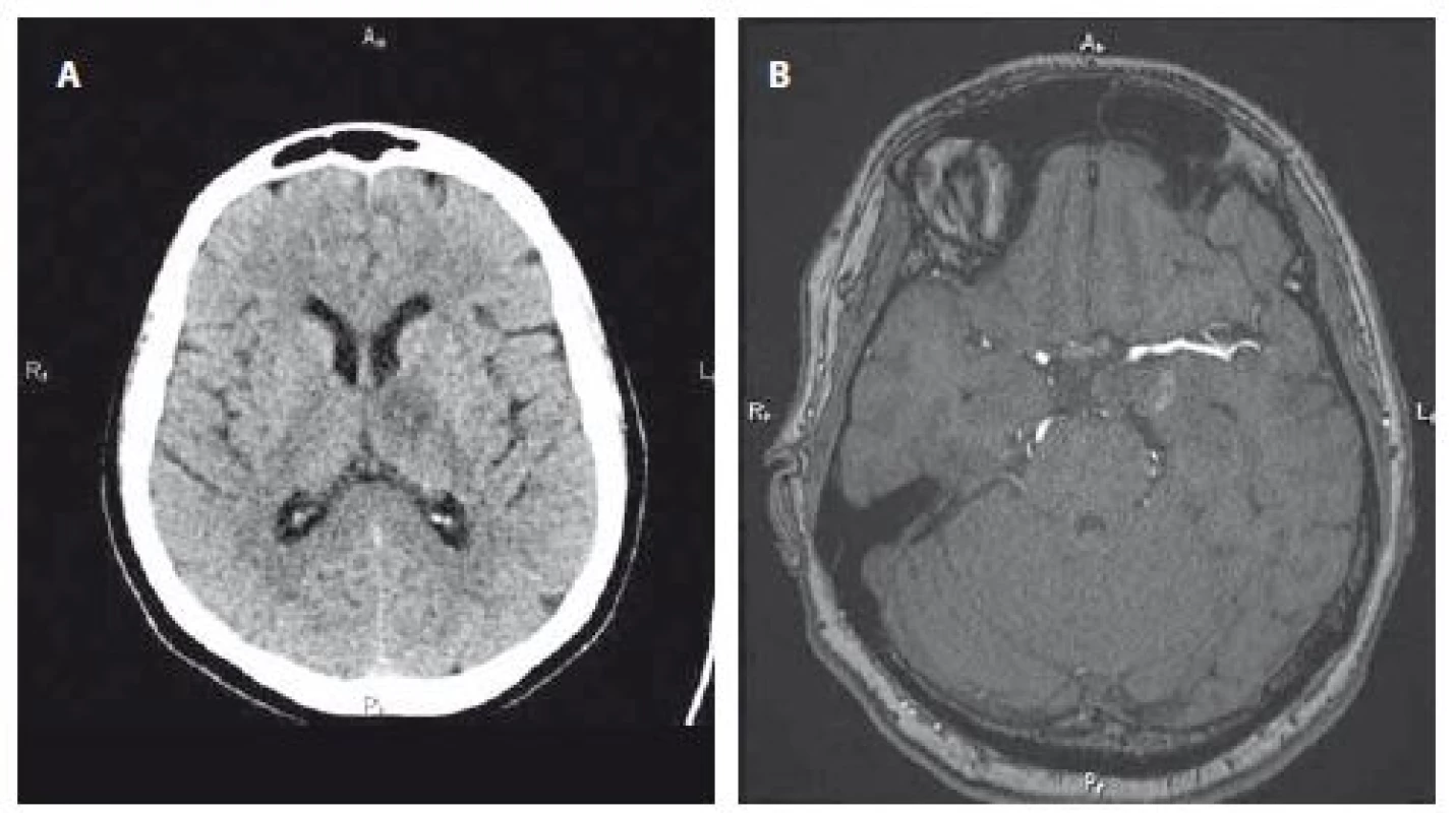 A – Kontrolní CT mozku 7. den od komplikace s novou neexpandující hypodenzitou v oblasti levého talamu v průměru cca 20 mm odpovídající subakutní ischemii. B – Kontrolní MRA za 2 měsíce po intervenci s plnou obliterací aneuryzmatu.<br>
Fig. 2. A – Control brain CT on the 7th day from a complication with a new non-expanding hypodensity in the left thalamic area, approximately 20 mm in diameter, corresponding with subacute ischaemia. B – Control MRA 2 months after intervention with full aneurysm obliteration.