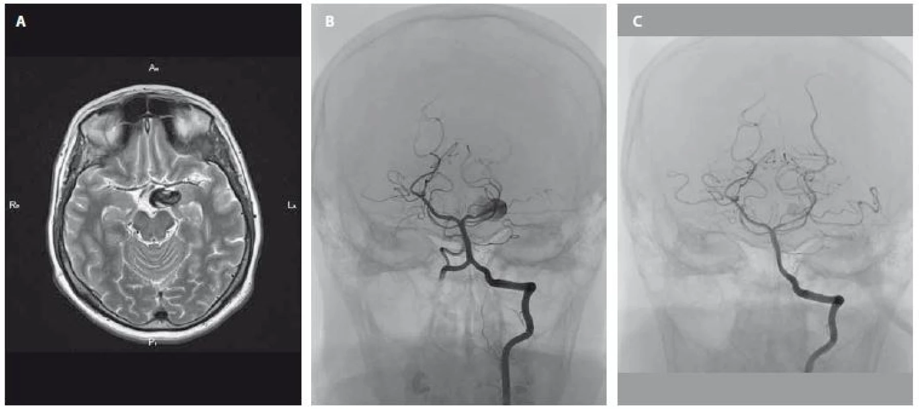 Zčásti trombózované aneuryzma velikosti 23 × 16 × 11 mm v blízkosti úseku P1 arteria cerebri posterior vlevo před ošetřením
(A – MR, B – DSA). C – kontrolní DSA aneuryzmatu po úspěšném zavedení flow-diverteru.<br>
Fig. 1. Partially thrombosed aneurysm (size 23 × 16 × 11 mm) near the P1 section of the cerebral posterior artery before treatment
(A – MRI, B – DSA). C – control DSA of aneurysm after successful endovascular treatment with a flow-diverter.