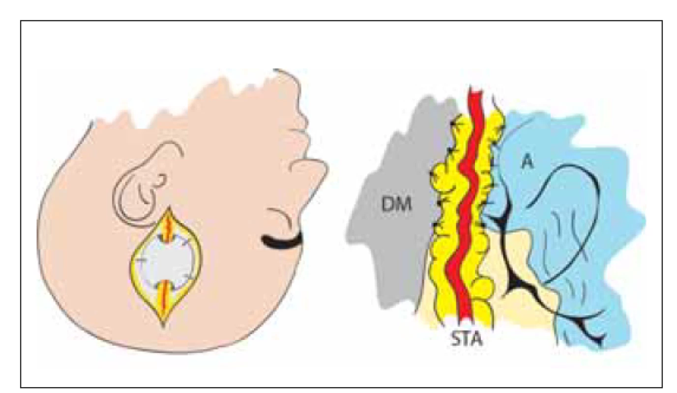 Nepřímá revaskularizace – encefalo-duro-arterio-synangióza.
Našití STA, která je ponechaná v kontinuitě, k DM a A. Tím je
dosaženo kontaktu tepny s povrchem mozku a neoangiogeneze.<br>
A – arachnoidea; DM – dura mater; STA – arteria temporalis
superfi cialis<br>
Fig. 6. Indirect revascularization – encephalo-duro-arterio-synangiosis.
STA in continuity is sutured to DM and A. Contact of artery
with brain surface induces neoangiogenesis.<br>
A – arachnoidea; DM – dura mater; STA – superfi cial temporal artery