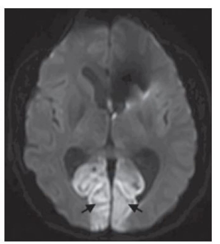 MR mozku, difuzí vážený obraz.<br>
Okcipitální ischémie v oblasti sulcus calcarinus
bilaterálně (černé šipky).<br>
Fig. 1. Brain MRI,diffusion weighted imaging.
Bilateral occipital cortical ischemia
in sulcus calcarinus (black arrows).