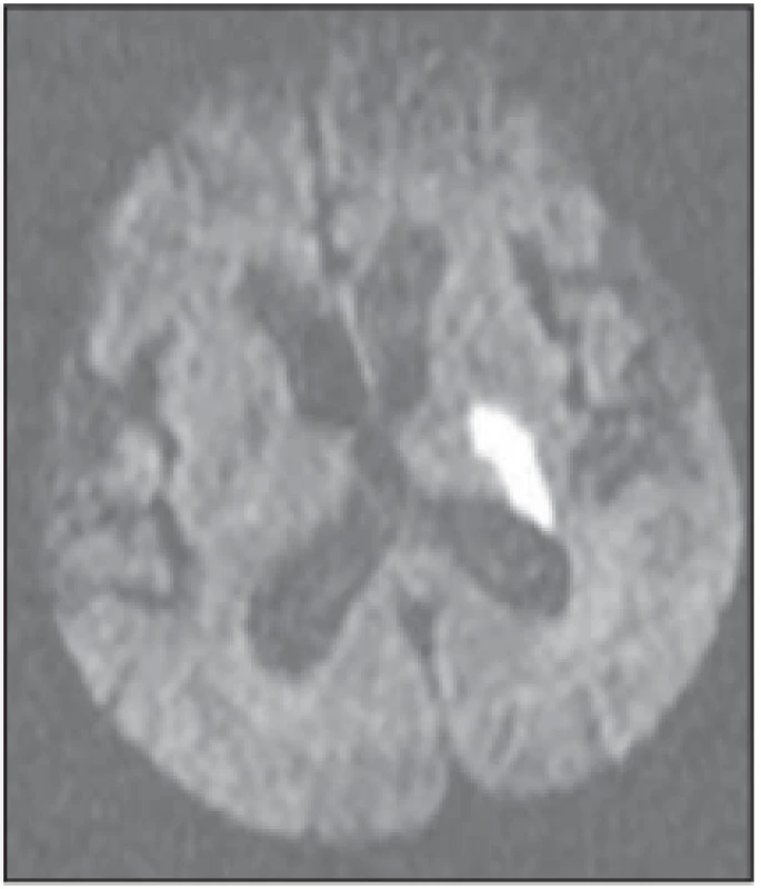 Difúziou vážená MR mozgu, b1000. 
Akútna ischemia v oblasti zadného 
ramienka capsuly interny vľavo.<br>
Fig. 1. Brain MR diff usion weighted image, 
b1000. Acute ischemia in the posterior 
part of the left internal capsule.