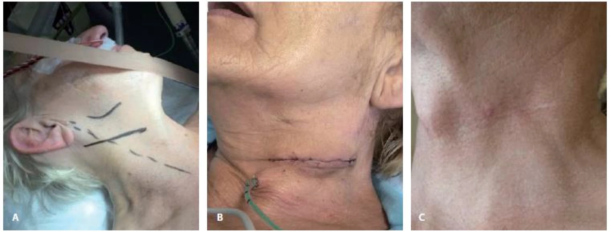 Předoperační (A), perioperační (B) a pooperační (C) obraz při použití příčného kožního řezu u karotické endarterektomie.<br>
Fig. 3. Preoperative (A), perioperative (B) and postoperative (C) images of transverse skin incision during carotid endarterectomy.