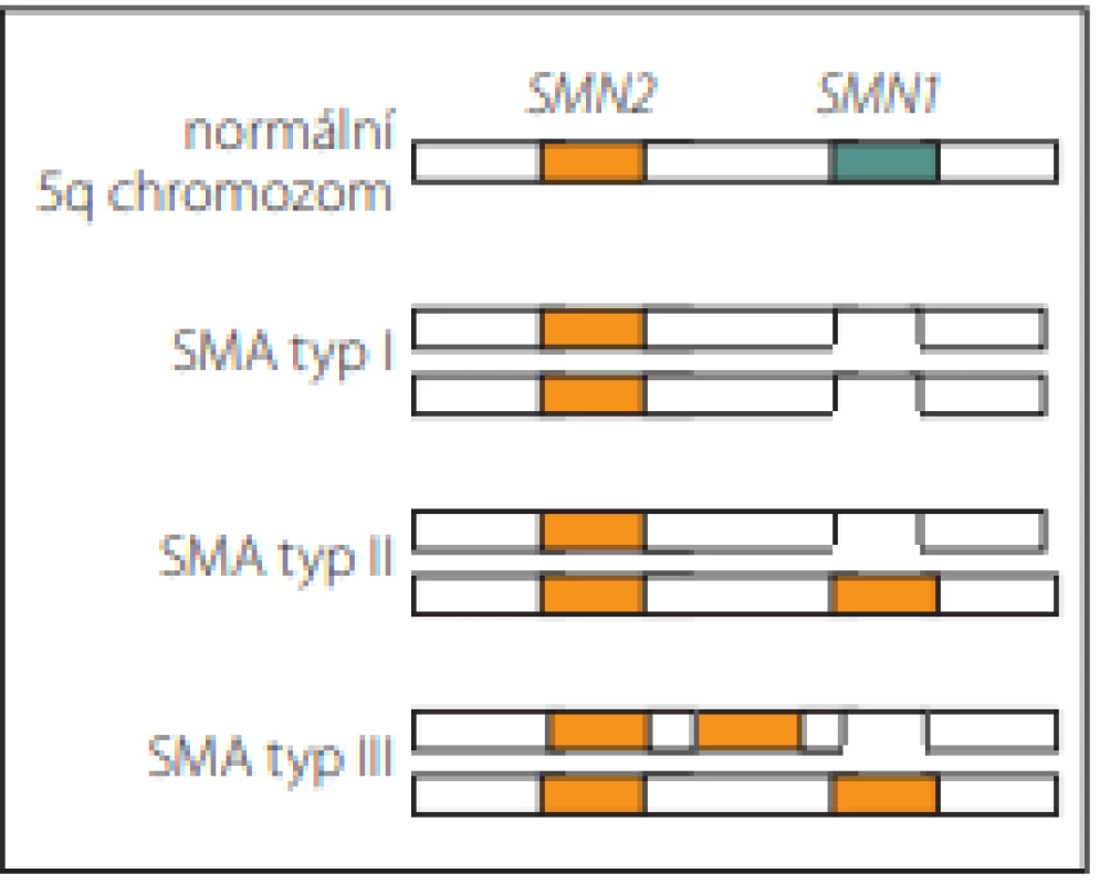 Typy SMA podle způsobu vyřazení
funkčního genu SMN1 [29].<br>
Fig. 3. SMA types based on the way of
disabling of functional SMN1 gene [29].