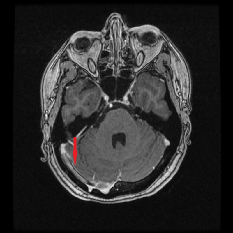MR s kontrastní látkou s odstupem 4 měsíců od implantace stentu. Červená šipka ukazuje místo plně průchodného stentu. <br>
Fig. 4. MRI with contrast four months after stent implantation. The red arrow indicates the location of the fully permeable stent.