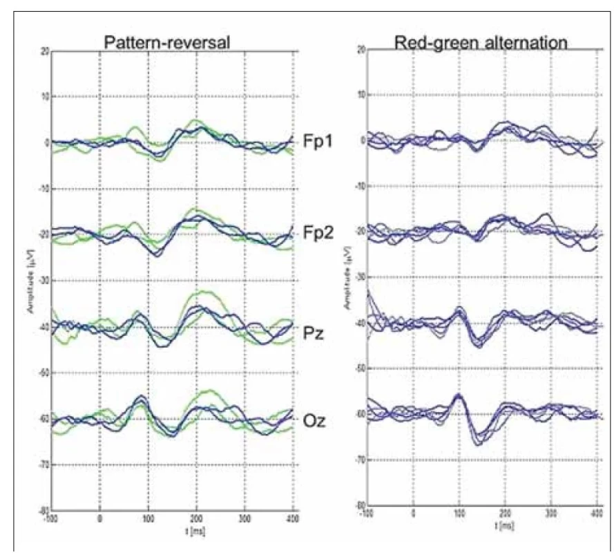 Demonstrace zobrazení opakovaných záznamů VEP při reverzační stimulaci a alternující
červeno-zelené stimulaci (dosud standardně nepoužívána při VEP vyšetření). Je
vidět velmi dobrá intraindividuální stabilita obou typů VEP.<br>
VEP – zrakové evokované potenciály<br>
Fig. 5. Demonstration of repeated pattern-reversal VEP recordings and VEPs evoked by
alternating red-green stimulation (not routinely used by VEP examination as yet). There
is evident good intraindividual stability of both VEP types.<br>
VEP – visual evoked potentials