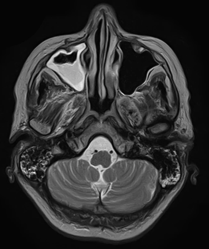 Brain MRI. Axial T2 weighted – progression of maxillar sinusitis, normal brainstem. <br>
Obr. 2. MR mozku. Axiální T2 vážený snímek – progrese sinusitis maxillaris. Normální nález v oblasti mozkového kmene.
