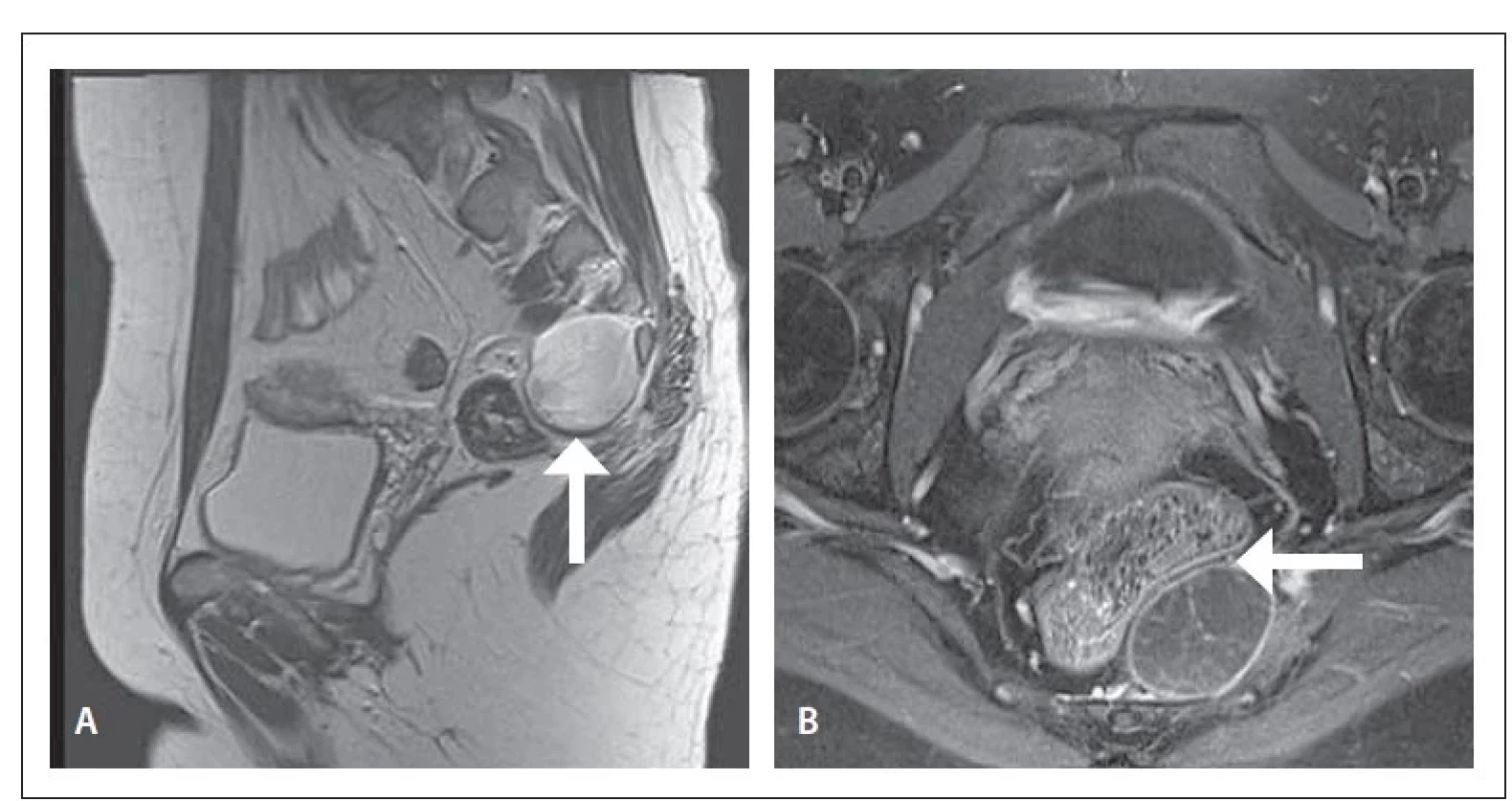 MR pánve. Presakrální neurofibrom s útlakem konečníku (šipka).<br>
Fig. 1. Pelvis MRI. Presacral neurofibroma with rectal compression (arrow).