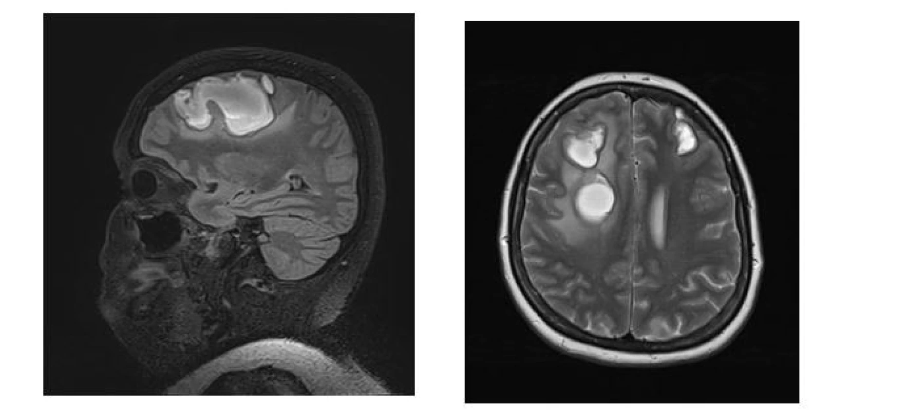 (A) Kontrolní MR vyšetření mozku – subakutní hematomy v T2 vážené FLAIR sekvenci s potlačením signálu tuku v sagitální rovině. (B) Kontrolní MR vyšetření mozku – subakutní hematomy v T2 vážené sekvenci v axiální rovině.<br>
Fig. 3. (A) MR brain scan – subacute hematomas in T2-weighted FLAIR sequence with fat signal suppression in the sagittal plane. MR brain scan – subacute hematomas in T2-weighted sequence in axial plane
