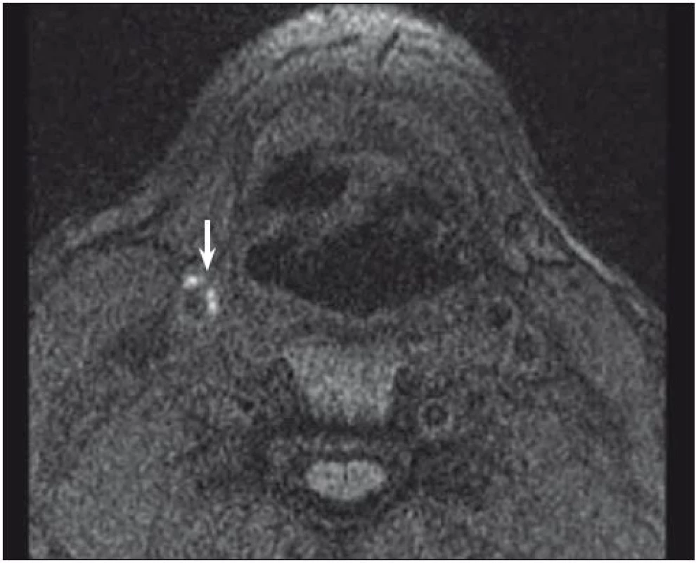 MR – hyperintenzní část (šipka) karotického plátu odpovídající krvácení do plátu.<br> Fig. 1. MRI – hyperintense part (arrow) of carotid plaque corresponding to intraplaque hemorrhage.