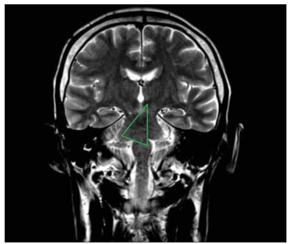 MR mozku, T2 vážená sekvence koronálně – znázornění Guillain-Molaretova
trojúhelníku.<br>
Horní vrchol vyznačuje levostranný nucleus ruber, dolní vrchol odpovídá poloze ipsilaterálního
dolního olivárního jádra, třetí vrchol kontralaterálně ukazuje místo pravostranného
nucleus dentatus.<br>
Fig. 1. Brain MRI, T2 weighted coronal sequence – depiction of the Guillain-Molaret triangle.<br>
The upper peak indicates the left-sided nucleus ruber, the lower peak corresponds to the
position of the ipsilateral inferior olivary nucleus, and the third peak contralaterally indicates
the location of the right-sided nucleus dentatus.