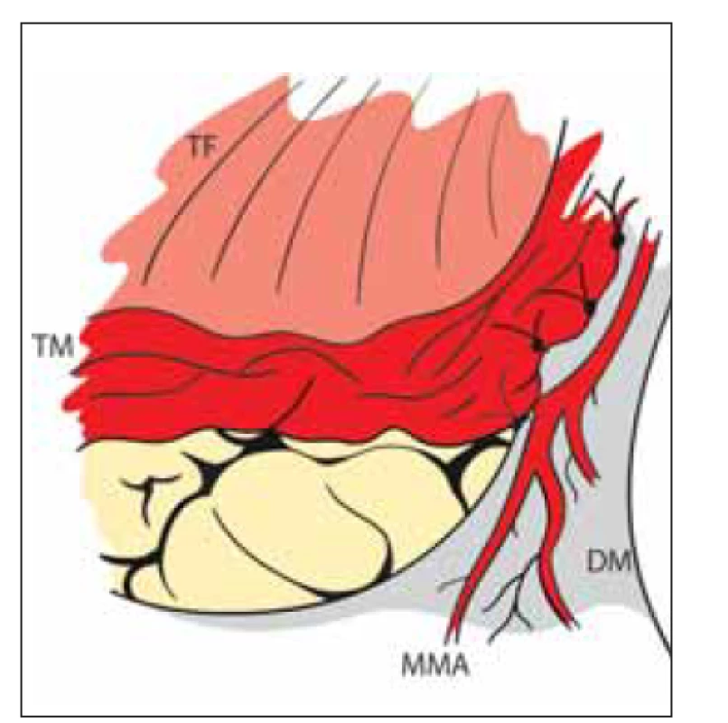 Nepřímá revaskularizace – encefalo-
myo-synangióza. Direktní přiložení
TM na mozek našitím do okénka DM se
zachovanou MMA.<br>
DM – dura mater; MMA – a. meningea
media; TF – temporální fascie; TM –
m. temporalis<br>
Fig. 5. Indirect revascularization – encephalo-
myo-synangiosis. TM is directly
attached to the brain surface by suturing
it into the DM window. MMA is preserved.<br>
DM – dura mater; MMA – middle meningeal
artery; TF – temporal fascia; TM – temporal
muscle