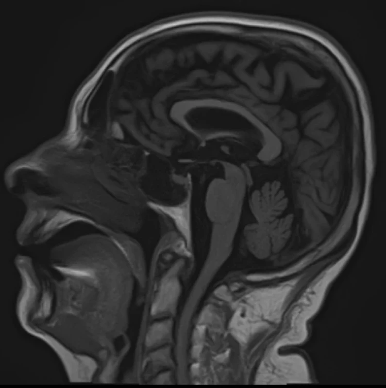 Brain MRI. Sagittal T1 weighted – normal structures of brainstem and corpus callosum. <br>
Obr. 3. MR mozku. Sagitální T1 vážený snímek – normální struktury mozkové kmene a corpus callosum.
