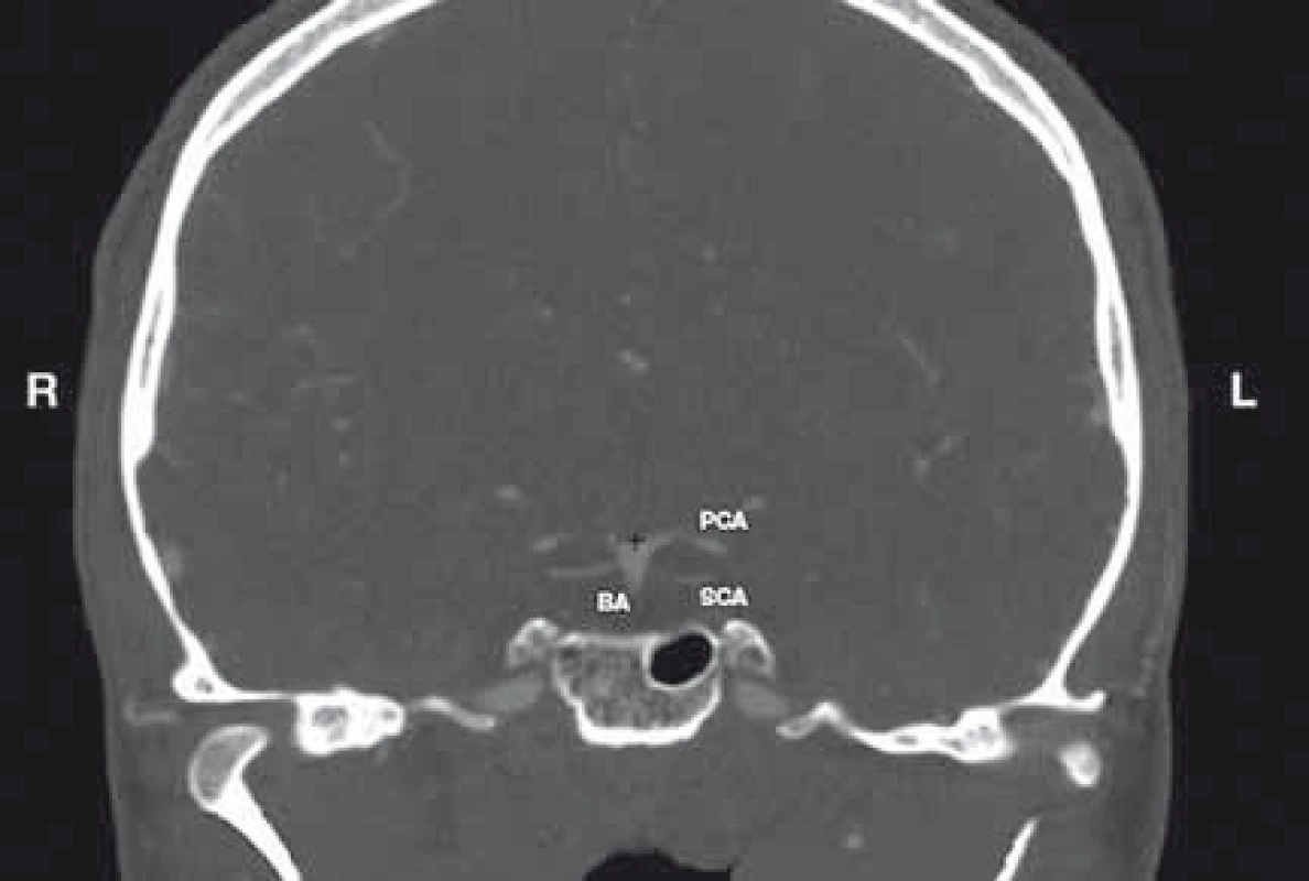 Determination of the BAB. Coronal reconstruction of CTA of the head.<br>
BA – basilar artery; BAB – basilar artery bifurcation; L – left; R – right; PCA – posterior cerebral artery; SCA – superior cerebellar artery<br>
+ a marker<br>
Obr. 1. Určení BAB. Koronární rekonstrukce CTA hlavy.<br>
BA – bazilární arterie; BAB – bifurkace bazilární arterie; L – vlevo;
PCA – arteria cerebri posterior; R – vpravo; SCA – arteria cerebelli
superior
+ označení