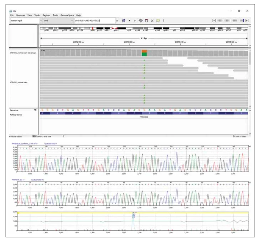 Výsledky sekvenačních analýz. (A) Celoexomové sekvenování DNA pacientky ukazující patogenní variantu c.592G>A/p.E198K
v genu PPP2R5D v programu Integrative Genomics Viewer (Broad Institute and the Regents of the University of California, USA).
(B) Část sekvence genu PPP2R5D s heterozygotní variantou c.592G>A/p.E198K potvrzená u pacientky Sangerovým sekvenováním.<br>
Fig. 2. Results of the sequencing analysis. (A) Exome sequencing of the patient’s DNA presenting pathogenic variant c.592G>A/p.
E198K in the PPP2R5D gene visualized using the Integrative Genomics Viewer software (Broad Institute and the Regents of the
University of California, USA). (B) Part of the PPP2R5D gene sequence showing heterozygous variant c.592G>A/p.E198K confi rmed
in the patient by Sanger sequencing.
