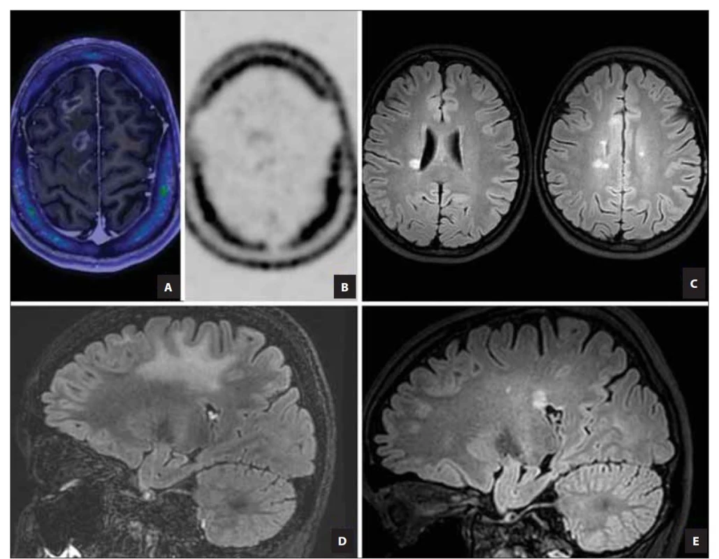 PET MR (fúzní a T1 postkontrastní zobrazení) mozku s radiofarmakem 18F-fluorothymidinem ukazují nevýraznou aktivitu lézí
(A, B). Kontrolní MR mozku (sagitální FLAIR sekvence), na snímcích nově typické periventrikulární léze (C). Perifokální edém tumoriformních
demyelinizačních ložisek (zobrazení FLAIR sagitálně) (D) ve srovnání se zobrazením stejného řezu při vyšetření po roce a půl.
Na snímku perifokální edém vymizel. Nově jsou zobrazeny drobné periventrikulární léze (E).<br>
FLAIR – fluid attenuated inversion recovery<br>
Fig. 2. Brain PET-MRI (fusion image of T1 contrast enhanced with FLT-PET) with the radiopharmaceutical 18F-fluorothymidine shows
insignificant lesion activity (A, B). Dissemination in time (on follow-up MRI – transverse FLAIR sequence), with new typical periventricular
lesions (C). Perifocal edema of tumefactive demyelinating lesion, on the right (D) comparison on control after a year and a half
where the perifocal oedema disappeared and small periventricular lesions appeared (E) shown on FLAIR sequences.<br>
FLAIR – fluid attenuated inversion recovery; FLT – 18F-fluorothymidine