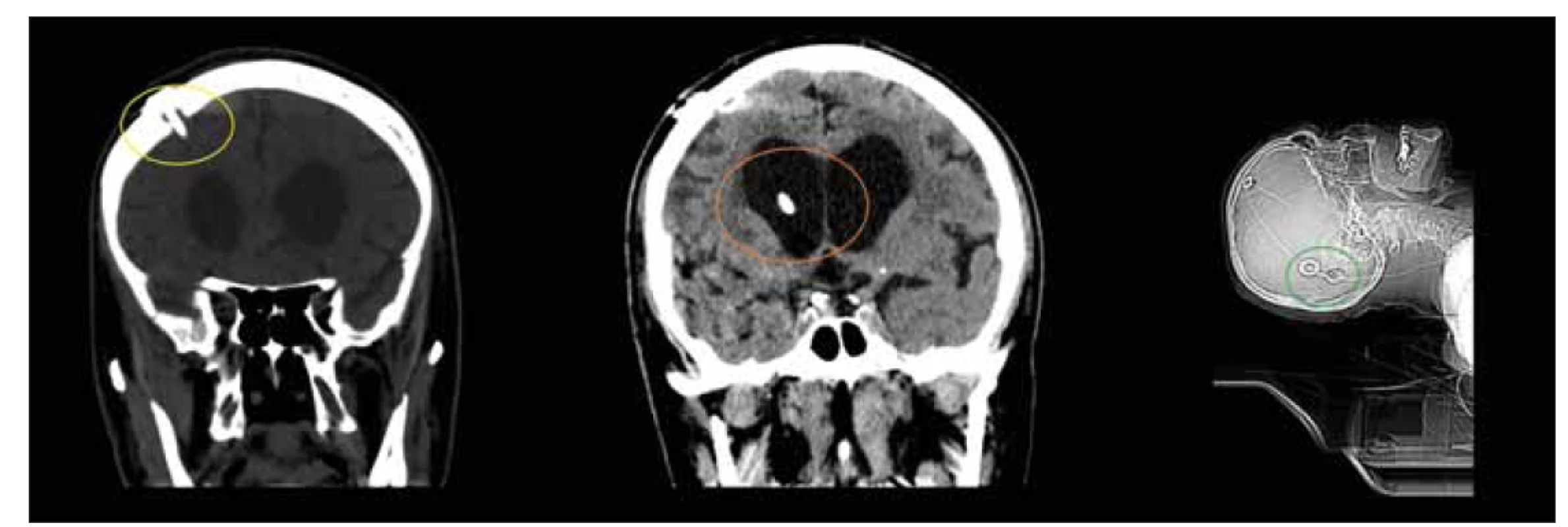 CT, frontální a sagitální rovina. Pacient den po implantaci ventrikuloperitoneálního zkratu. Povšimněte si pozice návrtu (žlutý
kruh) a ventrikulárního katétru (oranžový kruh) při implantaci ventrikulárního katétru z Kocherova bodu. Důležité je dosáhnout paralelní
polohy s podélnou osou těla při implantaci gravitačních ventilů (zelený kruh).<br>
Fig. 9. CT, coronal and sagittal plane. Patient on the day after the implantation of ventriculoperitoneal shunt. Note the positions of the
burrhole (yellow circle) and ventricular catheter (orange circle) when implanting the ventricular catheter from the Kocher point. It is
important to achieve a position parallel to the longitudinal axis of the body when implanting gravity valves (green circle).