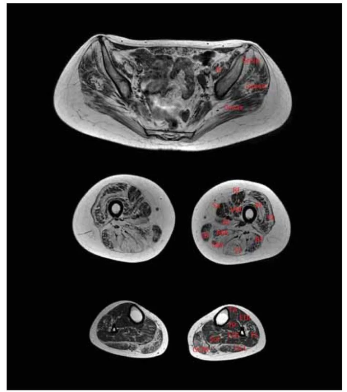 MR, T1 vážený obraz svalů dolních končetin. Pacientka s LGMD R1 calpain
3-related. Symetrická fibrotizace a tuková přestavba, v oblasti pánve patrná zejména
u hýžďových svalů, v oblasti stehen maximum změn v zadním kompartmentu
(m. semitendinosus, m. semimenbranosus, m. biceps femoris), relativně ušetřené
m. rectus femoris, m. sartorius, v oblasti lýtek postiženy zejména mm. gastrocnemii.<br>
AL – m. adductor longus; AM – m. adductor magnus; BF – m. biceps femoris (caput longum);
EDL – m. extensor digitorum longus; FDL – flexor digitorum longus; GCL – m. gastrocnemius
lateralis; GCM – m. gastrocnemius medialis; Gmin – m. gluteus minimus; Gmed – m. gluteus
medius; Gmax – m. gluteus maximus; Gr – m. gracilis; IP – m. iliopsoas; LGMD – pletencové
svalové dystrofie; PL – m. peroneus longus; RF – m. rectus femoris; Sa – m. sartorius;
SM – m. semimembranosus; ST – m. semitendinosus; VI – m. vastus intermedius;
TP – m. tibialis posterior; VL – m. vastus lateralis; VM – m. vastus medialis<br>
Fig. 2. T1-weighted MRI of lower limb muscles. Patient with LGMD R1 calpain 3-related.
Symmetrical fibrosis and fat replacement in the pelvic area especially in the gluteal
muscles; in the thighs, the maximal changes were in the posterior compartment (semitendinosus
muscle, semimembranosus muscle, m. biceps femoris), which relatively spared
the rectus femoris, sartorius; in the calves, mainly m. gastrocnemii were affected.<br>
AL – adductor longus muscle; AM – adductor magnus muscle; BF – biceps femoris muscle
(caput longum); EDL – extensor digitorum longus muscle; FDL – flexor digitorum longus
muscle; GCL – gastrocnemius lateralis muscle; GCM – gastrocnemius medialis muscle;
Gmin – gluteus minimus muscle; Gmed – gluteus medius muscle; Gmax – gluteus maximus
muscle; Gr – gracilis muscle; IP – iliopsoas muscle; LGMD – limb girdle muscular dystrophy;
PL – peroneus longus muscle; RF – rectus femoris muscle; Sa – sartorius muscle; SM – semimembranosus
muscle; ST – semitendinosus muscle; VI – vastus intermedius muscle;
TP – tibialis posterior muscle; VL – vastus lateralis muscle; VM – vastus medialis muscle