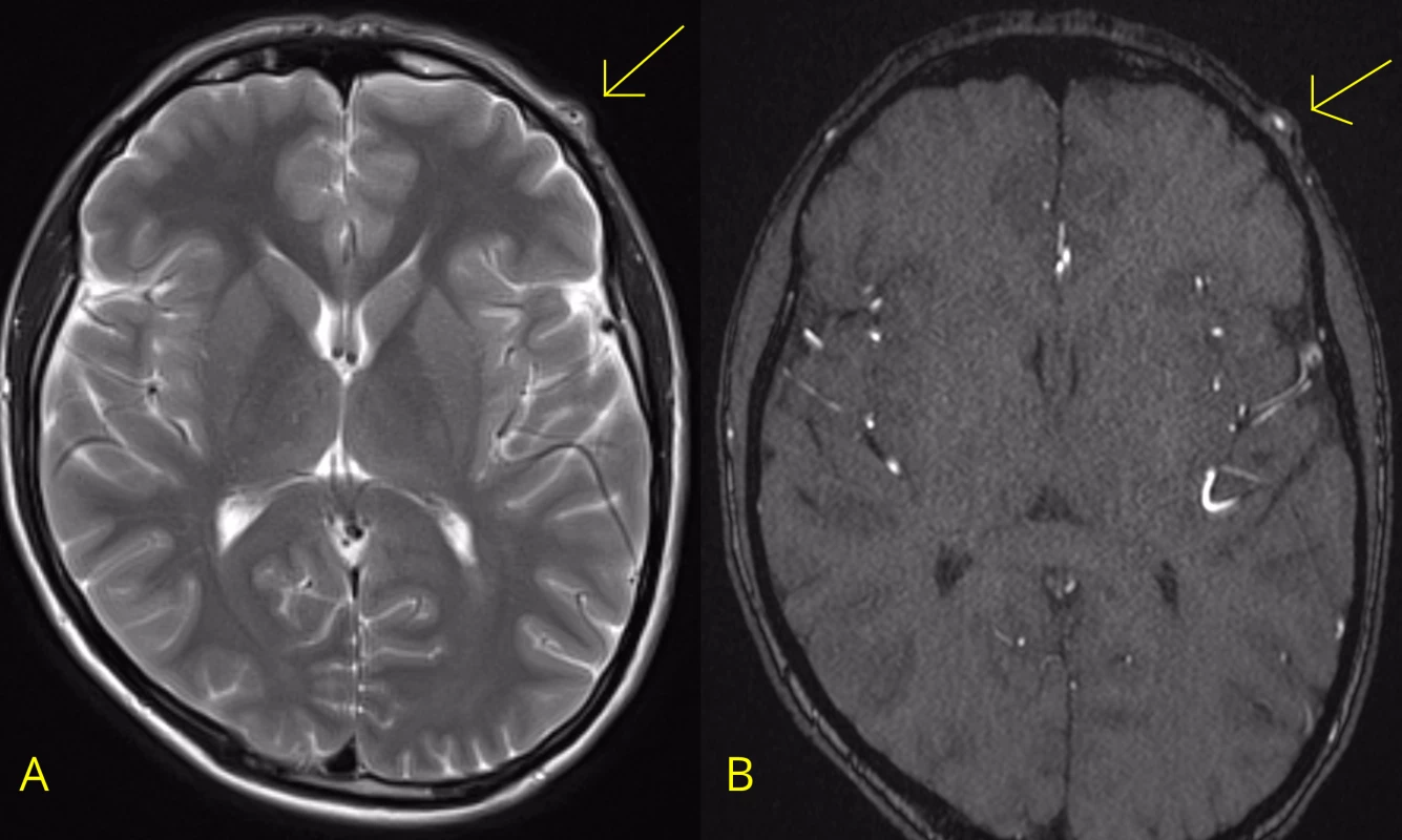 A – MR mozku (T2 vážené axiální skeny), šipka znázorňuje pseudoaneuryzma arteria temporalis superficial.; B – MRA mozku (time-of-flight [TOF] 3D multi-slab), šipka znázorňuje pseudoaneuryzma a. temporalis superficial.<br>
Fig. 2. A – MRI of the brain (T2-weighted axial scans), arrow shows a superficial temporal artery pseudoaneurysm; B – MRI of the brain (time-of-flight [TOF] 3D multi-slab), arrow shows a superficial temporal artery pseudoaneurysm.