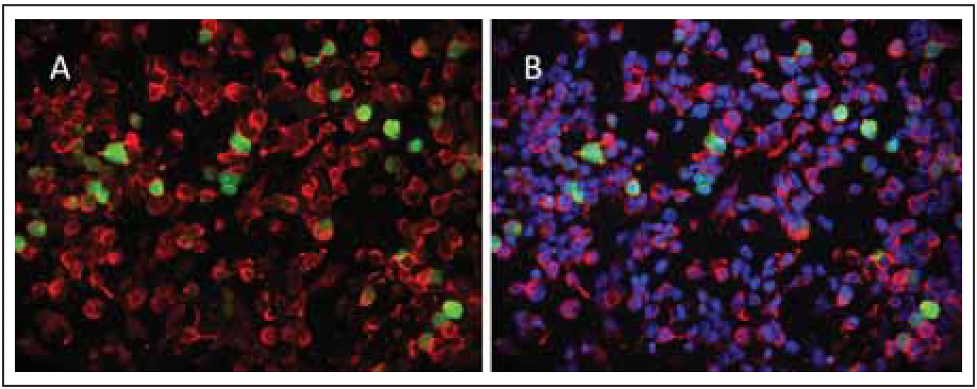Cell-based assay, kde jsou HEK buňky transfekovány plazmidem kódujícím
izoformu M23 AQP4. Současná kotransfekce EGFP (zelené zbarvení).<br>
Fig. 3. In-house cell-based assay for AQP4-IgG (isoform M23) with cotransfection of
EGFP (green colour).