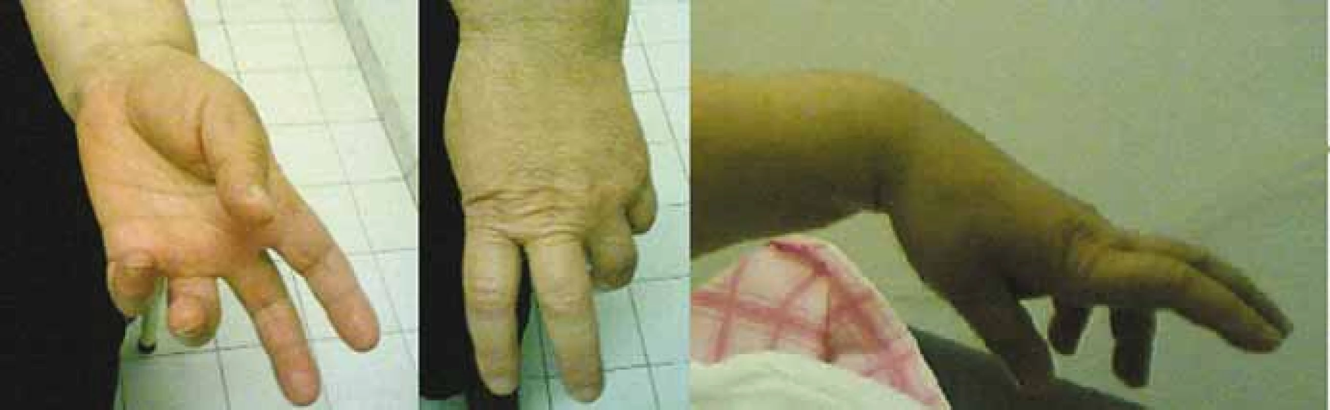 A, B – Benediction sign is a wrist position which is mimicked by ulnar paralysis;
C – prominent wrist extensor weakness.<br>
Obr. 1. A, B – Příznak Benediktova syndromu je poloha zápěstí, která se podobá ulnární
paralýze; C – nápadná slabost extenzorů zápěstí.