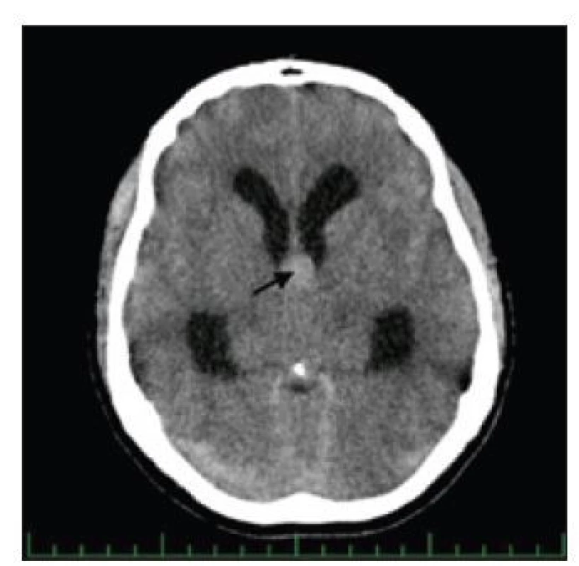 CT mozku, transverzální řez.<br>
Cystický útvar III. komory mozkové (černá
šipka).<br>
Fig. 1. Brain CT, transversal plane. Colloid
cyst of the third ventricle (black arrow).