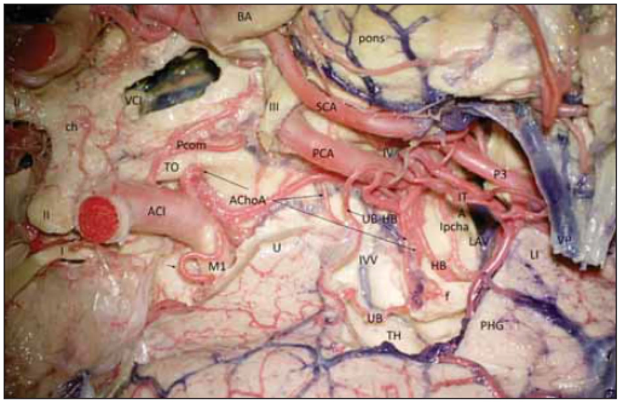Cévní zásobení hipokampálního komplexu vpravo (preparát s cévami barvenými
silikonem). <br>
Fig. 3 Vascular supply of the hippocampal complex (dyed silicon perfusion) on the right
side.