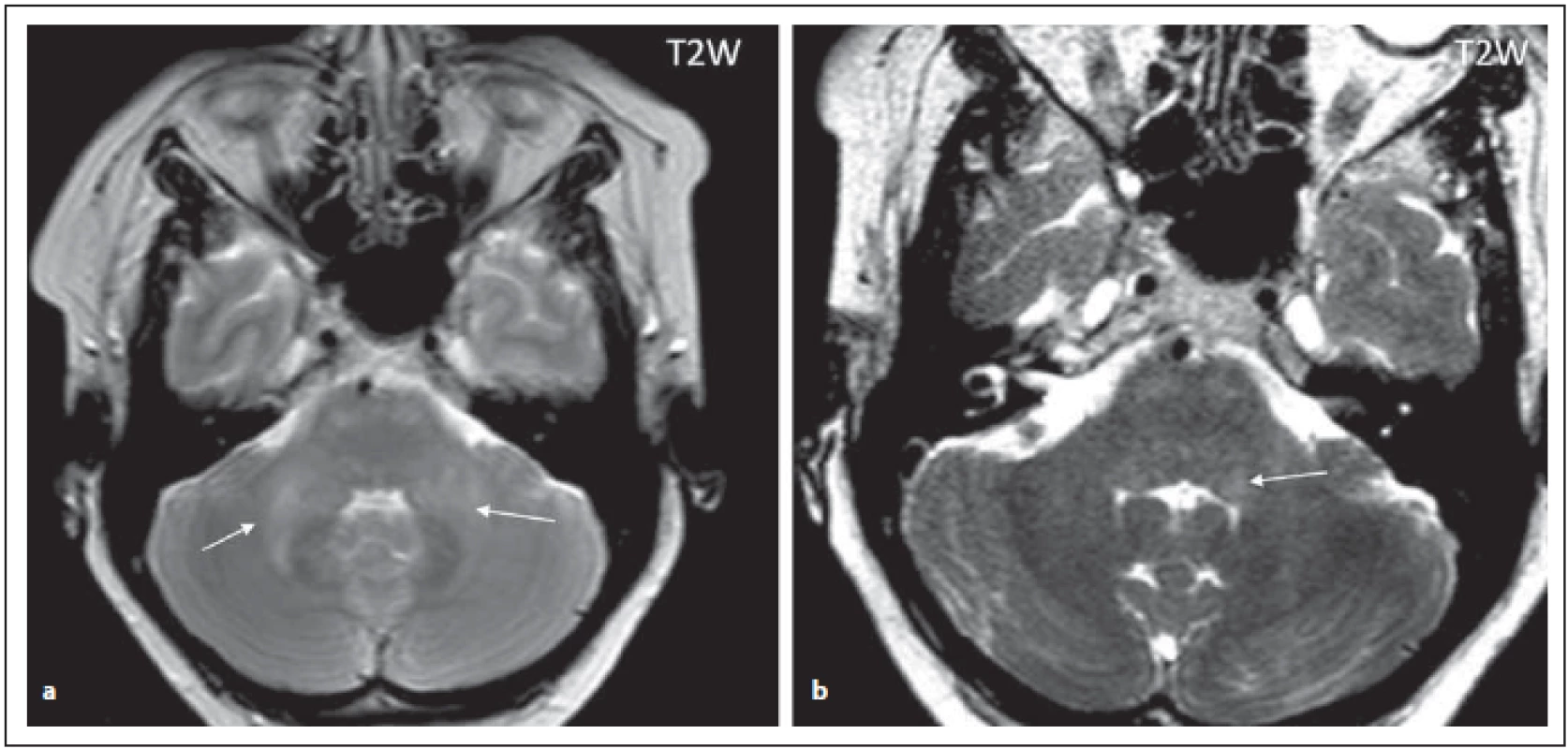 Pacient s AQP4-IgGpozNMOSD, difuzní zvýšení signálu v T2 váženém obraze v oblasti středních mozečkových pedunkulů (šipky)
(a), vlevo zasahující ke IV. komoře (detailněji zobrazeno na obrázku b (šipka)), diskrétní ložiska zvýšeného signálu i v oblasti přední části
pontu.<br>
Fig. 2. AQP4-IgGposNMOSD patient, T2-weighted image, diff use hypersignal in cerebellar peduncles (arrows), transversal cut (a),
adjacent to the fourth ventricle on the left side (for detail, see fi gure b (arrow)), discrete hypersignal lesions in ventral pons.