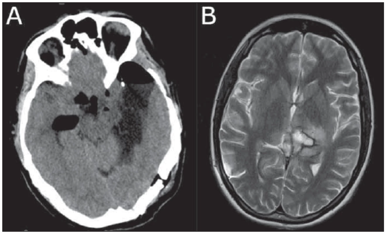 Pooperační snímky dvou pacientů
operovaných transtentoriálním přístupem. <br>
Fig. 2 Postoperative images of two
patients operated on by the transtentorial
approach. 