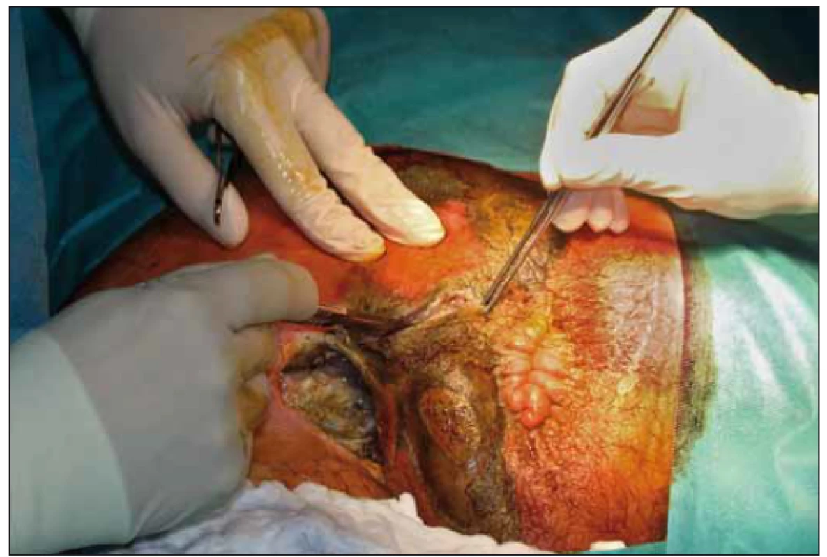 První nekrektomie.<br>
Fig. 1. First necrectomy.