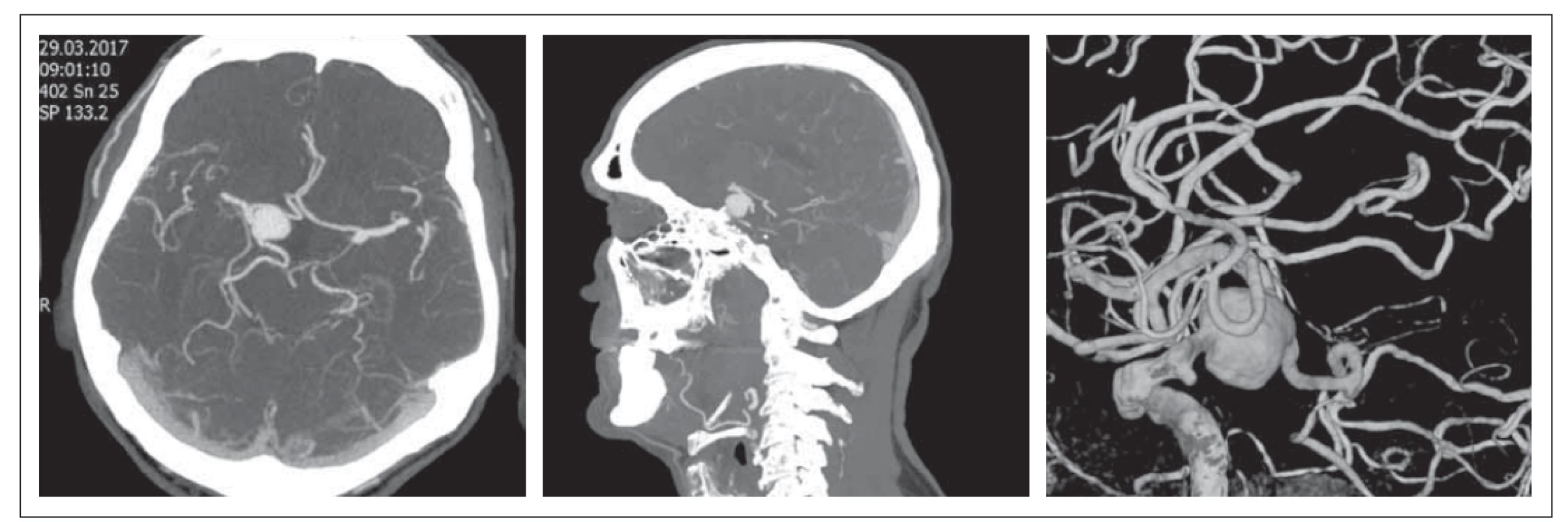 Obr. 1. MR mozku. Prolaktinom se supraselární propagací – červenec 2015.<br>
Fig. 1. Brain MRI. Prolactinoma with supraselar growth – July 2015.
