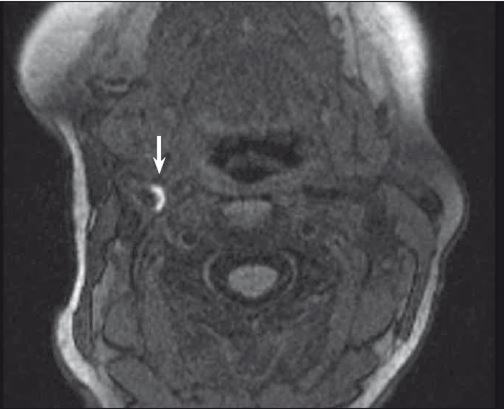 MR – hyperintenzní část (šipka) karotického plátu odpovídající krvácení do plátu.<br> Fig. 2. MRI – hyperintense part (arrow) of carotid plaque corresponding to intraplaque hemorrhage.