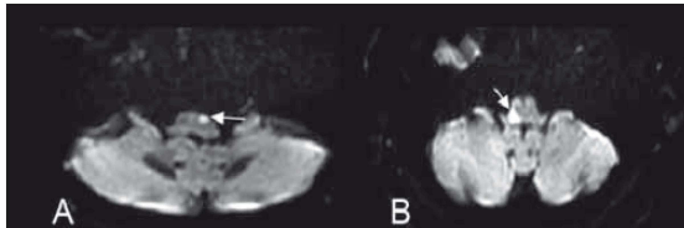(A) Obraz mediálního bulbárního syndromu dle Dejerina
a (B) laterálního medullárního syndromu dle Wallenberga na difuzí
vážených obrazech MR.<br>
Fig. 6. (A) Image of the medial medullary syndrome (Dejerine syndrome)
and (B) lateral medullary syndrome (Wallenberg syndrome)
on diff usion weighted MRI.