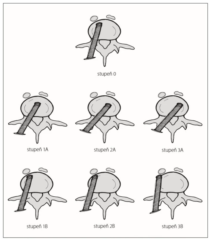 Modifikovaná klasifikace uložení pedikulárních šroubů dle Gertzbeina.<br>
Fig. 1. Modified Gertzbein´s grading scale of pedicular screw position.