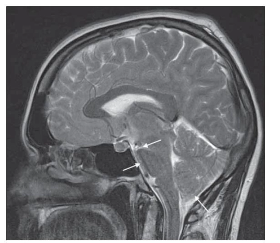MR obraz T2 vážený obraz „sagging brain“, kraniokaudálně:
zmenšení mamillopontinní vzdálenosti, zúžení prepontinní
cisterny a pokles mozečku k foramen magnum.<br>
Fig. 2. Brain MRI with bilateral subdural collections.