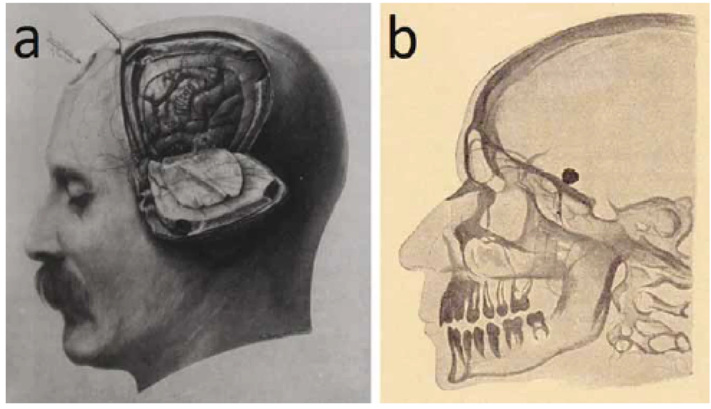 Historické snímky. (a) Vlastnoruční kresba Harveyho Cushinga zobrazující chirurgické
ošetření pacienta se střelným poraněním mozku z roku 1906 [21]. (b) Jedno z prvních
využití rentgenového vyšetření v neurochirurgii. Reprodukce snímku lbi s projektilem
v přední jámě lební dle Fedora Krause [138]. Kazuistika pochází z ledna roku 1900, tedy
necelých 5 let od vynálezu rentgenových paprsků Wilhelmem Konrádem Röntgenem.<br>
Fig. 1. Historical images. (a) Drawing from 1906 by Harvey Cushing depicting surgical
treatment of a patient with a gunshot wound to the head [21]. (b) One of the fi rst times
an X-ray was performed in neurosurgery. The drawing is reproduced from a skull radiogram
by Fedor Krause showing the presence of a projectile in the anterior fossa [138].
This case report originates from 1900, i.e. only 5 years after Wilhelm Conrad Röntgen
discovered the X-rays.