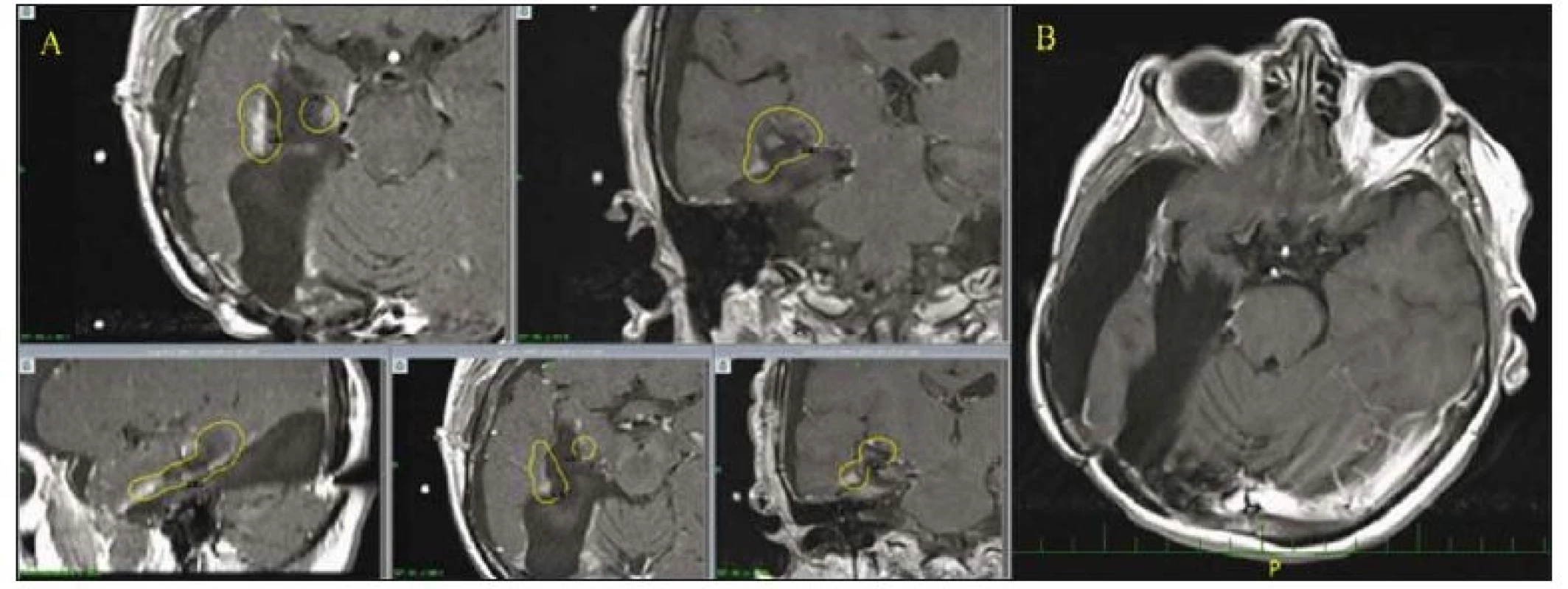 Pacientka ve věku 61 let s GBM temporookcipitálně vpravo a mediotemporálních struktur (hipokampus) po dvou operacích z okcipitálního
přístupu, po další operaci pro progresi rezidua z trannsylvijského přístupu, po konvenční radio- a chemoterapii s SRS boostem
pro reziduum po poslední operaci.
A – Na MR mozku (žlutou barvou zobrazena referenční isodosa) je patrné, že postkontrastně se sytící recidiva při poresekční dutině byla na
gama noži ozářena i s určitým bezpečnostním lemem 1,5–2 mm, výhodou je i lokalizace lézí při poresekční dutině – část integrální dávky, která
by zatěžovala zdravé okolní struktury a zvyšovala riziko komplikací, jde do poresekční dutiny. Rozložení dávky ozáření může též anatomicky
připomínat LERS oblasti fasciculus arcuatus a fimbria fornicis. B – Dlouhodobě uspokojivý grafický výsledek, subdurální kolekce není tenzní,
pacientka je v dobrém klinickém stavu, KPS 60 %, potřebuje asistenci manžela, chodí s ním na procházky.
GBM – multiformní glioblastom; KPS – Karnofsky performance score; LERS – leading edge radiosurgery; SRS – stereotaktická radiochirurgie<br>
Fig. 2. 61-year-old female with a GBM in the right temporooccipital region and in mesiotemporal structures (hippocampus) after two
operations using an occipital approach and a third trans-sylvian resection of a progressing residual lesion followed by conventional radio-
and chemotherapy plus SRS boost for a remnant after the last operation.
A – MRI scan (the yellow line marks the reference isodose curve) shows that the contrast enhancing recurrent lesion close to the postsurgical
cavity was irradiated by gamma knife with a safe margin of 1.5–2 mm, the proximity to the postsurgical cavity is an advantage – a fraction
of the whole radiation dose, which would burden healthy adjacent structures increasing the risk of neurological complications, is dispersed
into the postresectional cavity. The distribution of the irradiation reminds anatomically LERS (fasciculus arcuatus region and fimbria fornicis).
B – Long-term good radiologic outcome, the subdural cerebrospinal fluid pseudocyst is not tense, the patient is in a good conditions, KPS 60%,
she needs assistance from her husband, she goes for a walk with him.
GBM – glioblastoma multiforme; KPS – Karnofsky performance score; LERS – leading edge radiosurgery; SRS – stereotactic radiosurgery