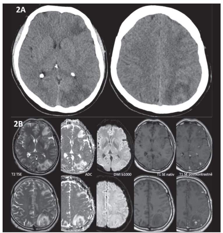 (A) Na nativní CT mozku 28 dní po CAS jsou znázorněny mapovité hypodenzity lokalizované v bílé hmotě subkortikálně ve
všech lalocích levé hemisféry, bez průkazu krvácení. (B) MR 28 dní po CAS znázorňuje patologický signál v subkortikální bílé hmotě
levé hemisféry, který odpovídá vazogennímu edému (T2 hyperintenzní, T1 nativně hypointenzní, ADC hyperintenzní, bez změny signálu
na DWI, tj. bez známek restrikce difuze). Změny jsou doprovázené vícečetnými okrsky patologického sycení leptomeningeálně
(hyperintenzní na T1 postkontrastně).<br>
ADC – apparent diffusion coefficient; CAS – stenting karotické arterie; DWI – difuzí vážené obrazy<br>
Fig. 2. (A) Non-contrast CT of the brain 28 days after CAS shows confluent white matter hypodensities in the subcortical regions of all
lobes of the left hemisphere, without hemorrhage. (B) MRI 28 days after CAS shows a pathological signal in the subcortical white matter
of the left hemisphere corresponding to vasogenic edema (T2 hyperintense, non-contrast T1 hypointense, ADC hyperintense, no
signal change on DWI, i.e., without signs of restricted diffusion). These changes are accompanied by numerous areas of pathological
leptomeningeal enhancement (hyperintense on contrast-enhanced T1).<br>
ADC – apparent diffusion coefficient; CAS – carotid artery stenting; DWI – diffusion-weighted imaging