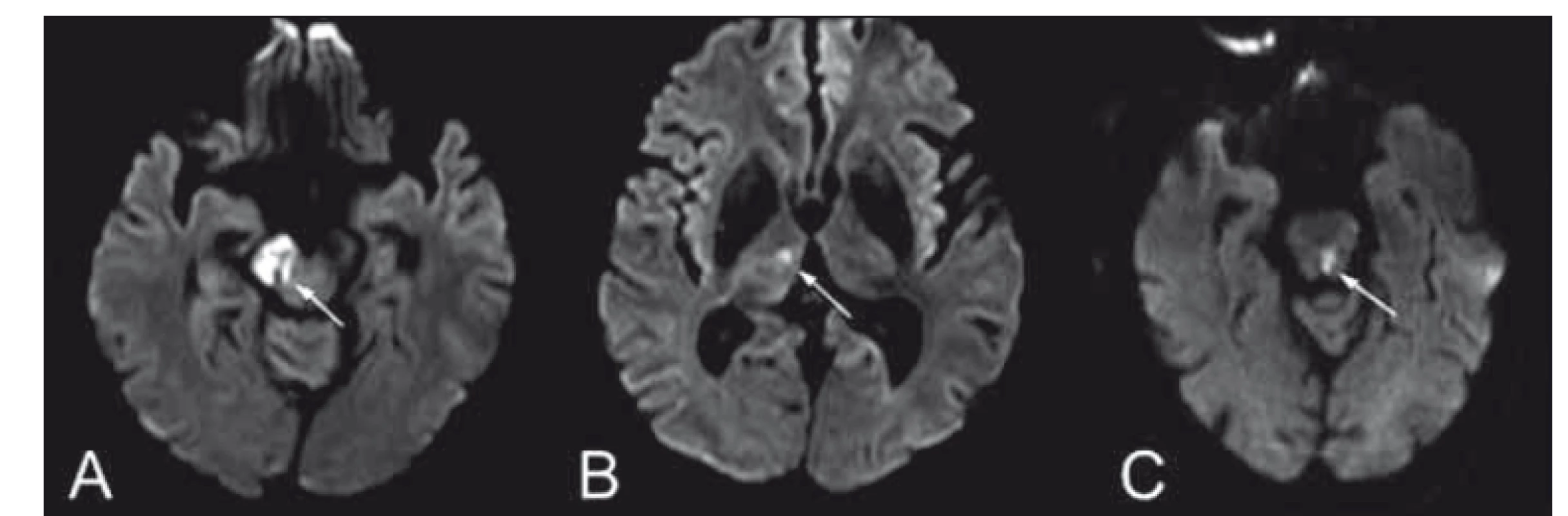 (A, B) Difuzí vážené obrazy MR – Weberův syndrom kombinovaný s talamickou
ischemií a (C) mediodorzální mezencefalický syndrom, spojený s okohybnou poruchou
- pravý bulbus deviován laterálně, levý bulbus s parézou mediálního pohledu, přítomen
dyskonjugovaný pohyb bulbů, nystagmus při vertikálním pohledu vzhůru, kvadruataxie
akcentovaná vpravo a dysartrie.<br>
Fig. 8. (A, B) Diff usion weighted MRIshowing an image of Weber syndrome in
combination with thalamic ischemia. (C) Mediodorsal mesencephalic syndrome
involving ophthalmoparesis – right eyeball deviated laterally, paresis of the medial
movement of the left eyeball, disconjugated eye movement, vertical upper gaze
nystagmus, quadriataxia and dysarthria.