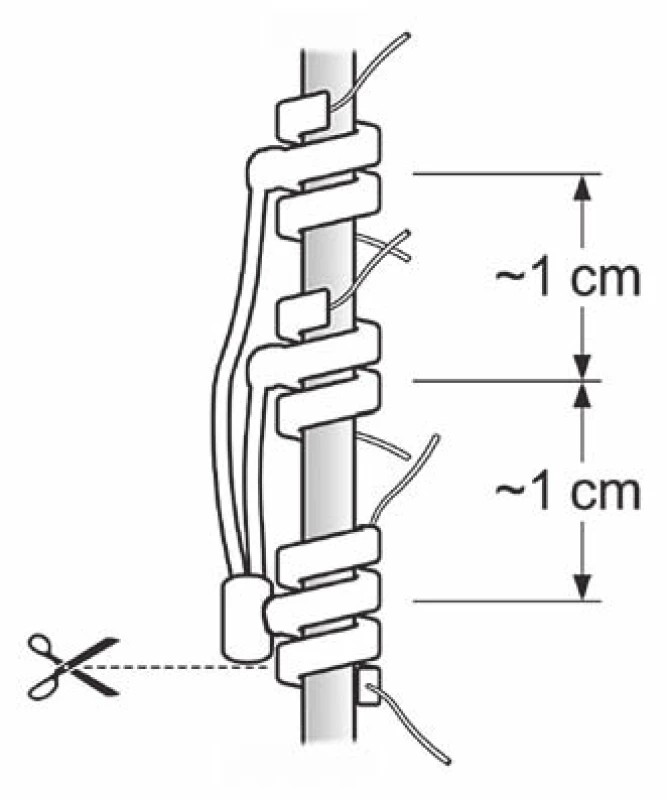 Zbytek elektrody ponechaný na vagovém nervu. Kotvička na obrázku dole je pouze fixační a je RTG nekontrastní.<br>
Fig. 3. The remainder of the electrode left on the vagal nerve. Lower anchor is only for fixation and is from X-ray non-contrast material.